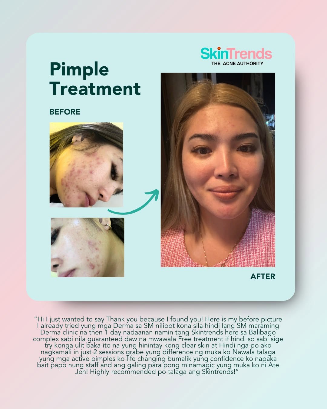 Skin Trends pimple treatment before and after — Female patient testimonial from Balibago: In just 2 sessions, the difference was life-changing. Highly recommended!