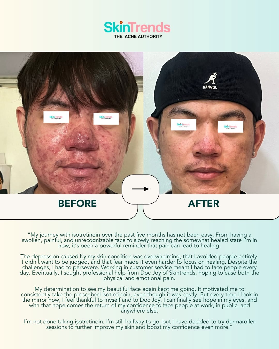 Skin Trends patient before and after isotretinoin treatment — From a swollen, painful, and unrecognizable face to healed skin. The patient shares: The depression caused by my skin condition was overwhelming. Eventually, I sought professional help from Doc Joy of Skintrends.